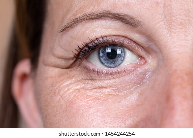 A Closeup And Front View On The Eye Area Of A Lady In Her 40s. Heavy Crow's Feet, Also Known As Laughter Lines, Are Seen Around The Eye. Skin Fatigue.