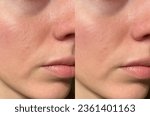 close-up girl with hyperhidrosis on her face and excessive oily sheen, with enlarged pores and nevus. before and after