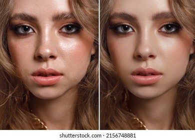 close-up girl with hyperhidrosis on her face and excessive oily sheen, with enlarged pores and bad tone. before and after treatment with botulinum toxin injections and cosmetological therapy