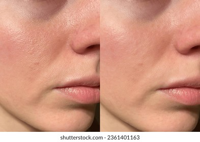 close-up girl with hyperhidrosis on her face and excessive oily sheen, with enlarged pores and nevus. before and after