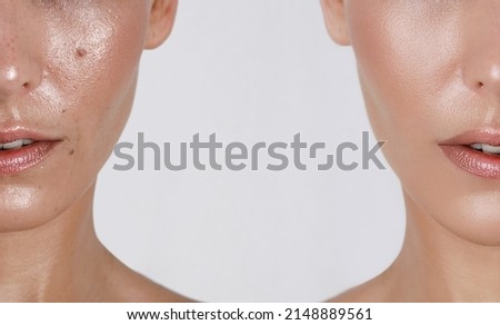 close-up girl with hyperhidrosis on her face and excessive oily sheen, with enlarged pores and nevus. before and after treatment with botulinum toxin injections