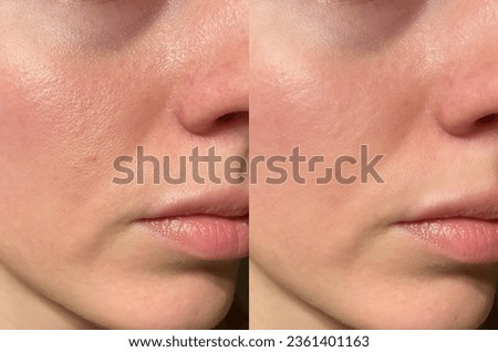 close-up girl with hyperhidrosis on her face and excessive oily sheen, with enlarged pores and nevus. before and after Stock fotó © 