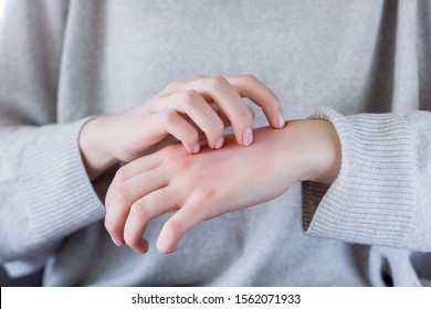 Closeup Girl Is Scratching Her Hand With Nails. Reddened, Inflamed Body Parts Causes Discomfort And Itching. Young Woman Is Suffering From Bouts Of Allergies. Dermatological Skin Diseases Concept.