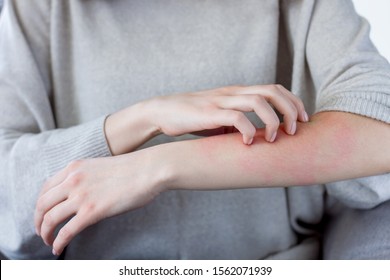 Closeup Girl Is Scratching Her Hand With Nails. Reddened, Inflamed Body Parts Causes Discomfort And Itching. Young Woman Is Suffering From Bouts Of Allergies. Dermatological Skin Diseases Concept.