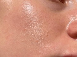 Close-up Girl With Sweaty Skin On Her Face And Excessive Oily Sheen, Excessive Sweating, Hyperhidrosis Disease