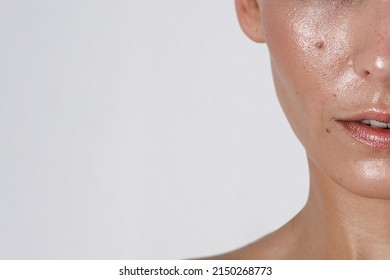 Close-up Girl With Sweaty Skin On Her Face And Excessive Oily Sheen, Excessive Sweating, Hyperhidrosis Disease