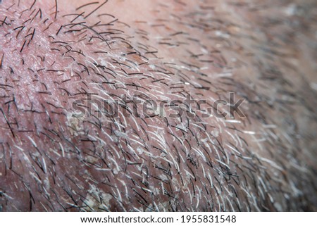 Close-up of a grown man's short-shaved beard. Skin damaged by shaving. Short bristles in soft focus at high magnification