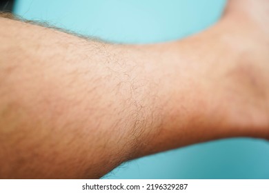 Close-up Of Hairy Skin. Hair On A Man's Leg