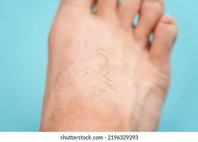 Close-up Of Hairy Skin. Hair On A Man's Leg