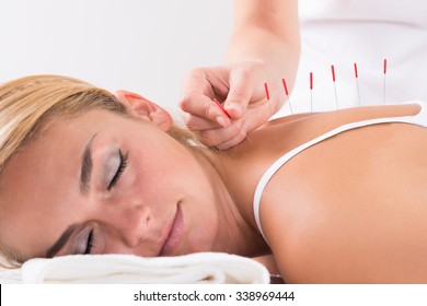 Closeup of hand performing acupuncture therapy on customer's back at salon - Powered by Shutterstock