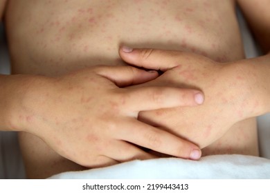 Close-up Of The Hands Of A Child With Rubella, Folded On The Stomach. A Child With Chickenpox Lies On His Back, Folded His Hands On His Stomach