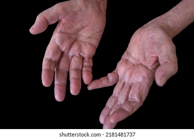 Close-up Of The Hands Of An Elderly Man With CIDP (Chronic Inflammatory Demyelinating Polyneuropathy) An Autoimmune Disease Of The Nervous System. Open Palms, Hand Gestures On Black Background. 