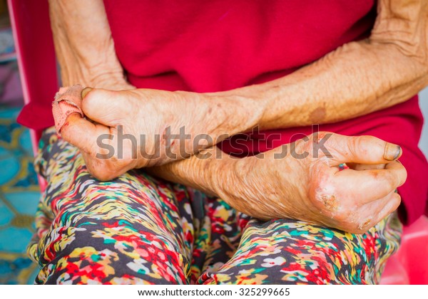 closeup hands of old woman suffering from leprosy,\
amputated hands, front\
view