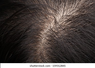 Closeup Head With Thinning Hair And Scalp