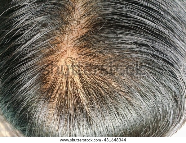 Closeup Head Thinning Hair Scalp Stock Photo Edit Now 431648344