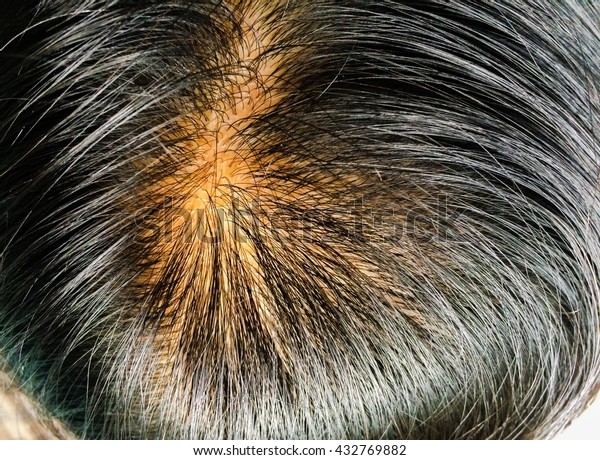 Closeup Head Thinning Hair Scalp Stock Photo Edit Now 432769882