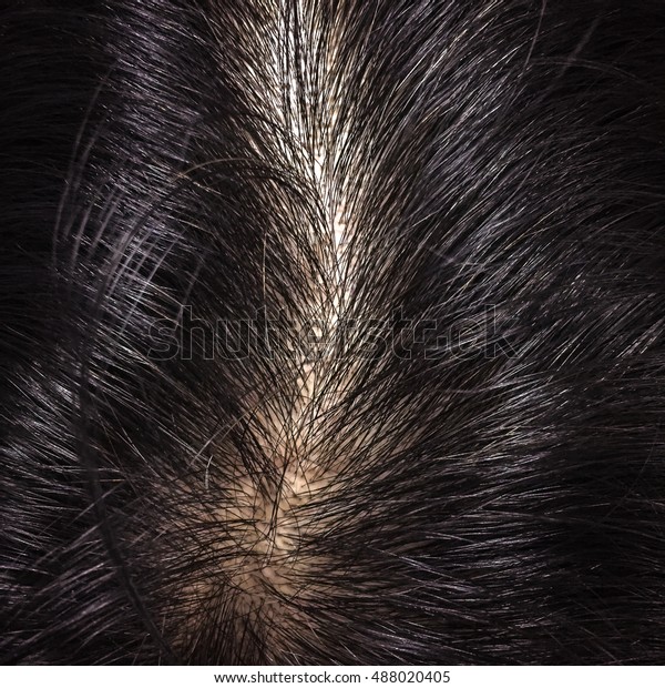Closeup Head Thinning Hair Scalp Stock Photo Edit Now 488020405