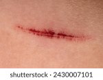 Close-up of a healed scar on skin. Macro shot with copy space.