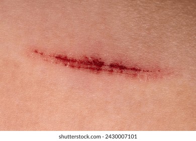 Close-up of a healed scar on skin. Macro shot with copy space.