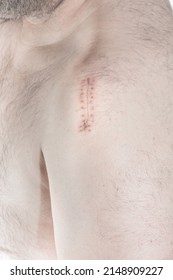 Close-up, high angle of a real scar after an operation for a broken humerus of the upper arm.