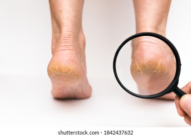 Closeup Highly dry heels woman on a white background through a magnifying glass.The doctors hand checks on how much cracked the skin is.