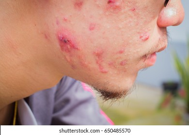 closeup horizontal photo of male cheek with big pimple or acne abcess.