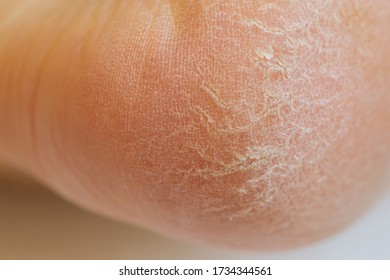 Closeup Of Horny Skin On A Heel 