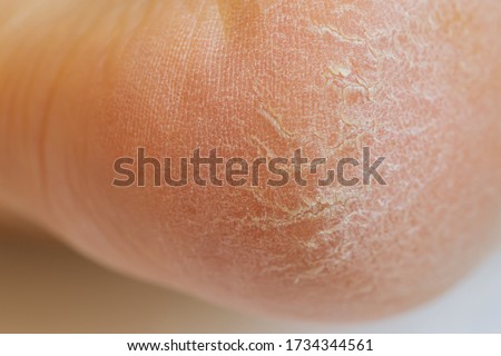 Closeup of horny skin on a heel 