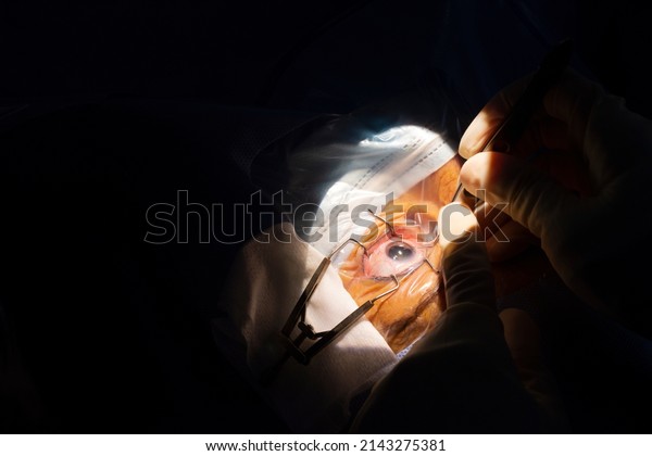Close-up of a human eye, cataract surgery in an\
ophthalmology operating room. Sterile drape and surgeon\'s hands\
with sterile gloves inserting a cataract forceps into the anterior\
chamber of the eye.