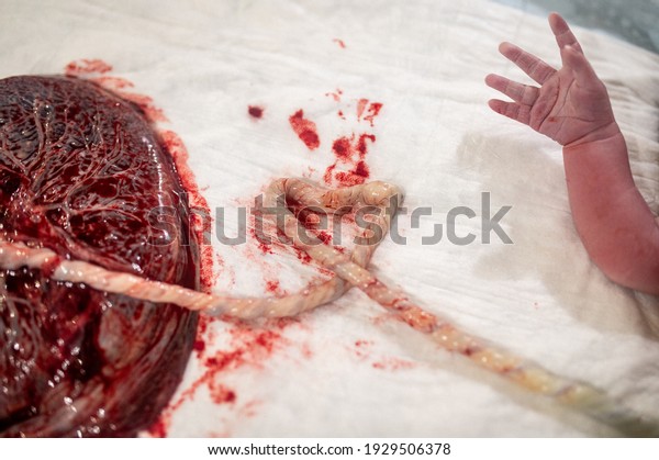 A closeup of a human placenta and a\
newborn child\'d hand on bedsheets in the\
hospital