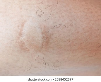 A Close-Up Of Human Skin With A Square Patch Of Discolored, Dry, And Slightly Peeling Skin. The Area Is Surrounded By Fine, Curled Hair Strands, And The Background Consists Of Natural Skin Texture