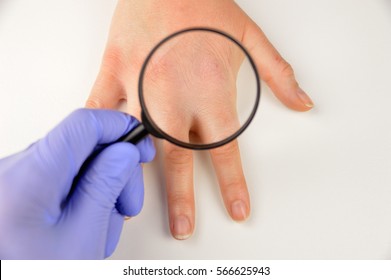 Closeup Image Of Doctor Checking With Magnifying Glasses The Hand With Very Dry Skin And Deep Cracks .