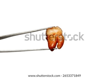 A close-up image of an extracted tooth being held by dental forceps against a white background. This photo highlights the surgical procedure of dental extraction.