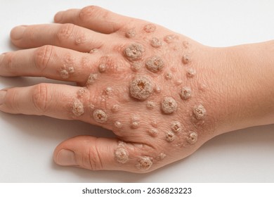 Close-up image of a human hand with multiple warts. Detailed skin texture showing severe viral skin infection caused by HPV. Medical dermatology reference.
