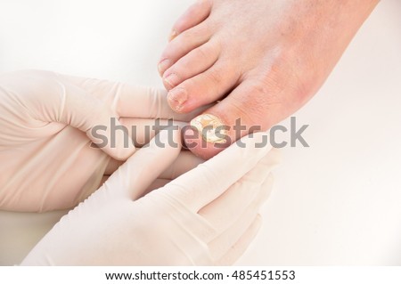 Closeup image of podologist checking the left foot toe nail suffering from fungus infection. horizontal studio picture on white background.