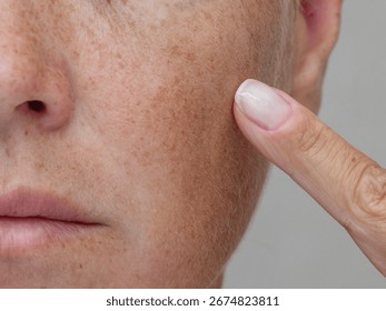 A close-up image showing a partial view of a woman's face, from below the eye to the chin, with her finger pointing at her freckles