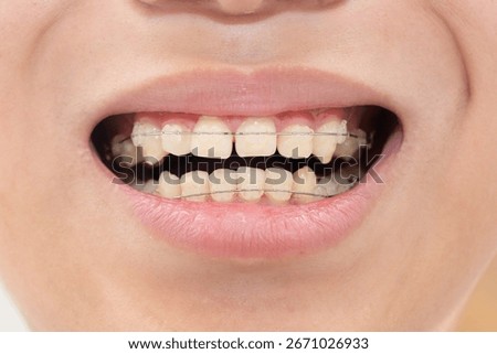 Close-up image of teeth correction
