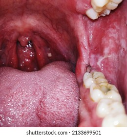 Closeup Inflamed Ulcerative Growth At Right Upper Gum In Oral Cavity And The Diagnosis Is Oral Cancer - Gum, Oral Care And Dentistry Treatment Concept.