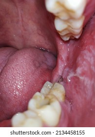 Closeup Inflamed Ulcerative Growth At Right Upper Gum In Oral Cavity And The Diagnosis Is Oral Cancer - Gum, Oral Care And Dentistry Treatment Concept. Selective Focus