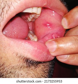 Closeup Inflamed Ulcerative Growth At Right Upper Gum In Oral Cavity And The Diagnosis Is Oral Cancer - Mouth Ulcer, Gum, Oral Care And Dentistry Treatment Concept. Selective Focus