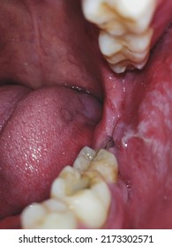 Closeup Inflamed Ulcerative Growth At Right Upper Gum In Oral Cavity And The Diagnosis Is Oral Cancer - Mouth Ulcer, Gum, Oral Care And Dentistry Treatment Concept. Selective Focus