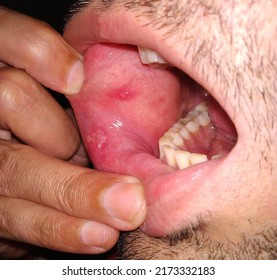 Closeup Inflamed Ulcerative Growth At Right Upper Gum In Oral Cavity And The Diagnosis Is Oral Cancer - Mouth Ulcer, Gum, Oral Care And Dentistry Treatment Concept. Selective Focus