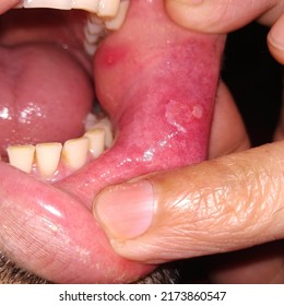 Closeup Inflamed Ulcerative Growth At Right Upper Gum In Oral Cavity And The Diagnosis Is Oral Cancer - Mouth Ulcer, Gum, Oral Care And Dentistry Treatment Concept. Selective Focus