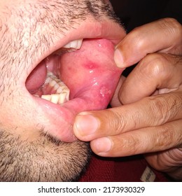 Closeup Inflamed Ulcerative Growth At Right Upper Gum In Oral Cavity And The Diagnosis Is Oral Cancer - Mouth Ulcer, Gum, Oral Care And Dentistry Treatment Concept. Selective Focus