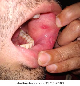 Closeup Inflamed Ulcerative Growth At Right Upper Gum In Oral Cavity And The Diagnosis Is Oral Cancer - Mouth Ulcer, Gum, Oral Care And Dentistry Treatment Concept. Selective Focus.