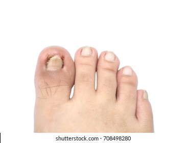 Closeup Ingrown Nail At The Big Toe Of A Man Isolated On White Background With Clipping Path