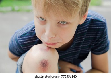 Closeup Of Injured Young Kid's Knee After He Fell Down On Pavement. Boy's Face And Wounded Scraped Leg On Summer Day Outdoors. Horizontal Color Photo.