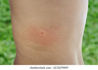 Close-up Of Insect Bite Wound. Male Body Stung By Wasp