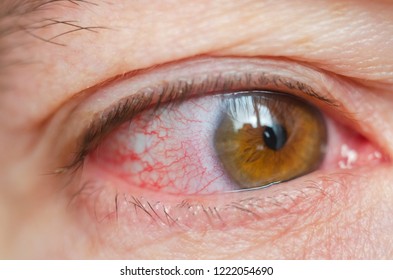 Closeup irritated infected red bloodshot eyes, conjunctivitis.