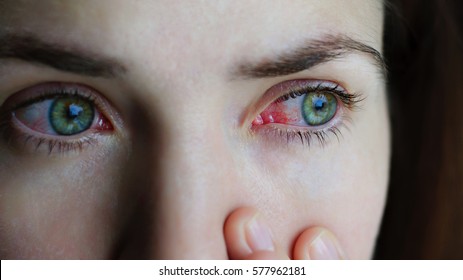 Closeup of irritated or infected red bloodshot eye - conjunctivitis